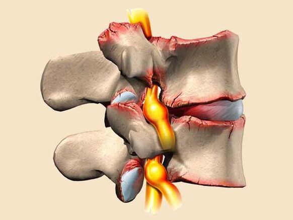 torasik osteokondrozda spinal yaralanma