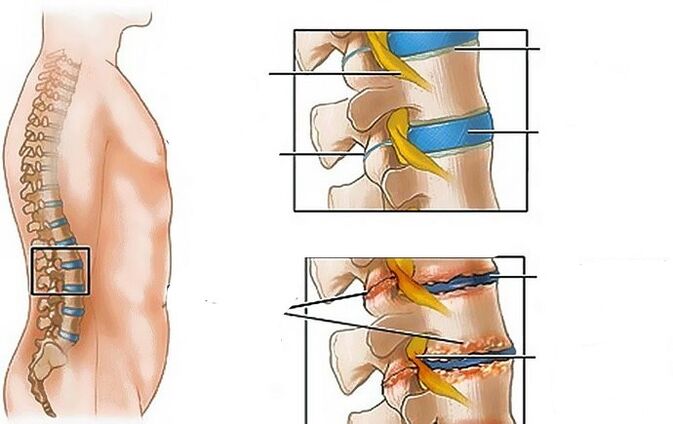 Lomber bölgenin osteokondrozu