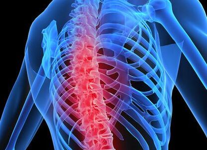 torasik omurganın osteokondrozu