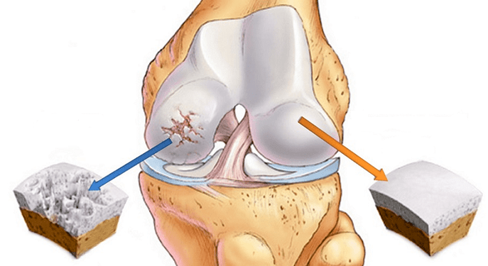Artrozdan etkilenen sağlıklı kıkırdak ve kıkırdak