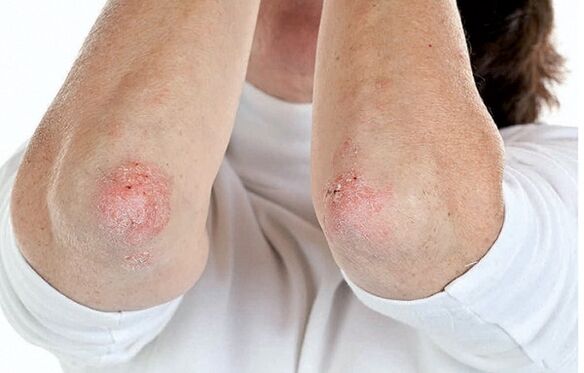 Sedef hastalığı olan kişiler psoriatik artrite karşı hassastır