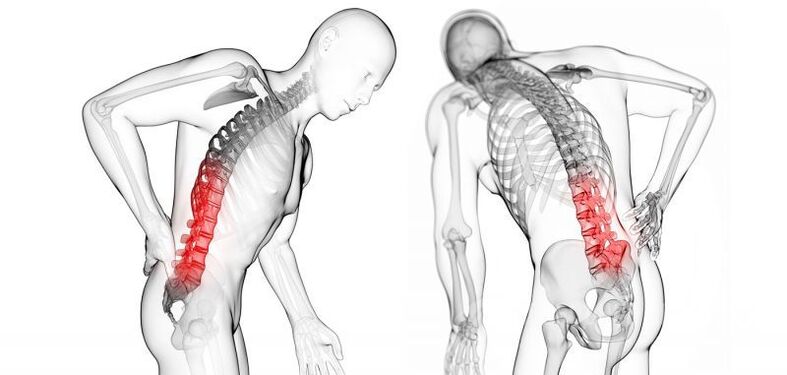 Servikal osteokondroz komplikasyonları